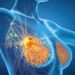 Cancro seno, con profilazione molecolare e terapie target migliori prospettive di cura