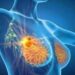Cancro seno iniziale Her2+, con anticorpo farmaco-coniugato -53% recidiva