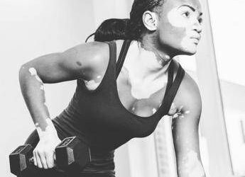 E’ la Vitiligine week, “così la terapia della luce aiuta il farmaco”