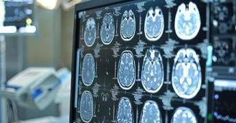 Ictus, esperti: “Asundexian apre nuovo capitolo prevenzione secondaria”