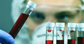 Leucemia linfatica cronica, con zanubrutinib sopravvivenza al 74% a 6 anni