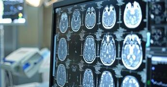 Sanità, presentato Deestrategy, modello per continuità assistenziale in encefalopatie rare