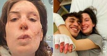 Crans-Montana, oggi dimessi due ragazzi. Eleonora Palmieri mostra le ustioni sui social