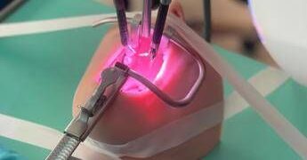 Intervento pionieristico al Meyer, rimossa una cisti sublinguale con il robot