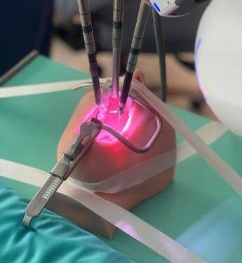 Intervento pionieristico al Meyer, rimossa una cisti sublinguale con il robot