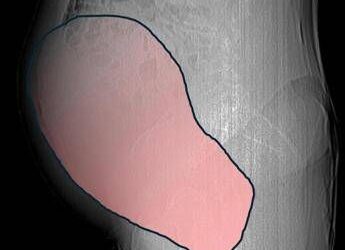 Intervento record al Sant’Anna di Torino, rimosso tumore ovarico di 6 kg