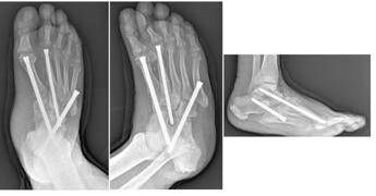 Piede di Charcot, al Gemelli soluzioni avanzate per una complicanza rara del diabete