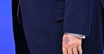 Trump e il nuovo livido sulla mano, tutte le ipotesi secondo Bassetti