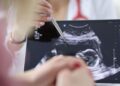 Chirurgia, si rompe l’aorta e viene operata con il bimbo in utero, intervento record a Milano