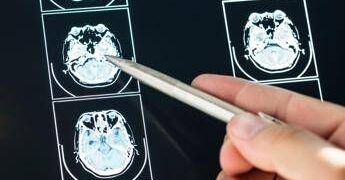 Ecco come il Long Covid cambia il cervello con meccanismi tipici dell’Alzheimer