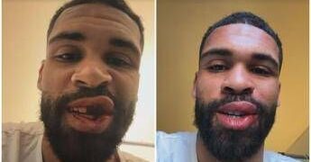 Loftus-Cheek, intervento riuscito alla mascella. E mostra foto dopo scontro in Milan-Parma