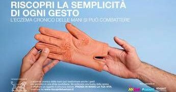 Mani che bruciano e fanno male, al via campagna su eczema cronico