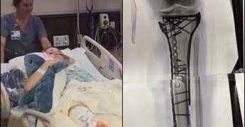 Milano Cortina, Vonn mostra la gamba dopo le operazioni: “Dolore difficile da gestire”