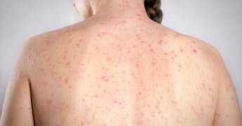 Morbillo, dagli aeroporti Usa alle scuole di Londra: dilagano gli alert