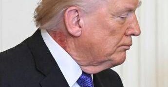 Trump e il collo arrossato, la foto riaccende i dubbi sulla salute del presidente