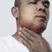 Angioedema ereditario, Aifa estende uso lanadelumab dai 2 anni di età