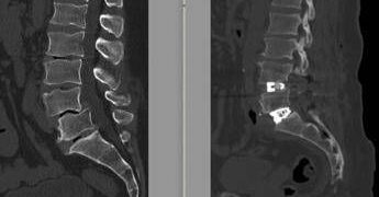 Chirurgia vertebrale complessa, al Tiberia Hospital di Roma intervento con tecnica Alif