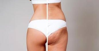 Gambe gonfie e cellulite per 8 donne su 10: la cura riparte dal sistema linfatico