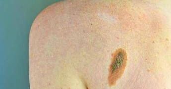 Ogni anno in Italia 2.600 casi ereditari di melanoma, Imi:”Prevenzione con test genetici e controlli”