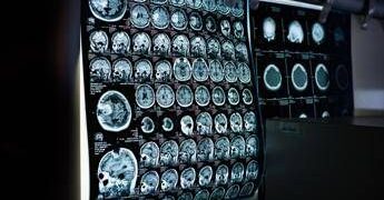 Uno spray nasale ferma l’invecchiamento del cervello, lo studio