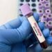 Giornata patologie eosinofile, allergologo Caminati: “Diagnosi complessa”