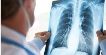 Cancro polmone Egfr-mutato, studio fase 3 Adaura: “Il 79% dei pazienti vivo a 8 anni con Osimertinib”