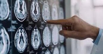 Malattia di Parkinson, ok in Europa a formulazione orale Ld/Cd a rilascio modificato
