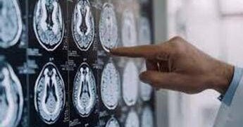 Parkinson, in Italia 300mila persone malate: 10% ha diagnosi prima dei 50 anni