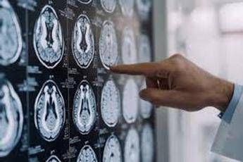 Parkinson, in Italia 300mila persone malate: 10% ha diagnosi prima dei 50 anni