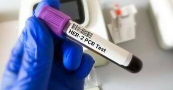 Tumore gastroesofageo Her2+, risultati positivi per tislelizumab con zanidatamab e chemio