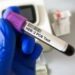 Tumore gastroesofageo Her2+, risultati positivi per tislelizumab con zanidatamab e chemio