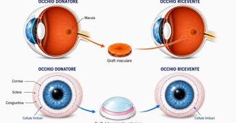 Torna a vedere dopo trapianto di retina da un occhio all’altro, è la prima volta al mondo