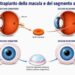 Torna a vedere dopo trapianto di retina da un occhio all’altro, è la prima volta al mondo