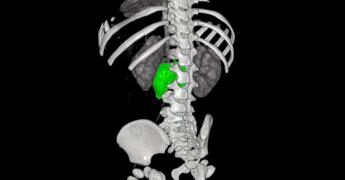 Chirurgia su misura, al Bambino Gesù di Roma rimosso complesso neuroblastoma a bimba di 1 anno