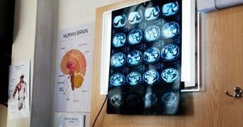 Di Battista, cosa indica un mal di testa forte e improvviso: le ipotesi del neurologo