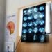 Di Battista, cosa indica un mal di testa forte e improvviso: le ipotesi del neurologo