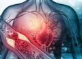 Arterosclerosi, studio: “Nuova molecola riduce di più il colesterolo cattivo”