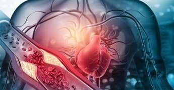 Arterosclerosi, studio: “Nuova molecola riduce di più il colesterolo cattivo”