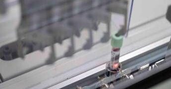 Cancro del pancreas, allo studio test del sangue per la diagnosi precoce