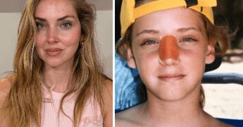 Chiara Ferragni, l’intervento al naso: “Ecco perché è storto ora”
