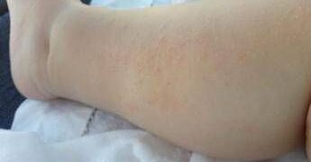 Dermatite atopica, Aifa estende rimborso di upadacitinib dai 12 anni di età