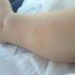 Dermatite atopica, Aifa estende rimborso di upadacitinib dai 12 anni di età