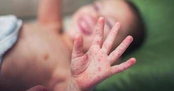 Morbillo, aumentano casi e ricoveri. Bassetti: “In Liguria focolaio senza precedenti, l’Italia rischia gravissima epidemia”