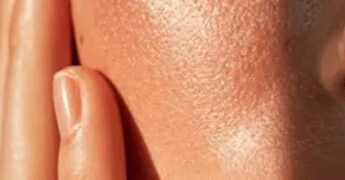 Ai, in Utah prescrizioni per l’acne via app senza intervento del medico
