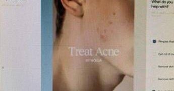 Ai prescrive farmaci contro l’acne, esperti Siiam: “Progresso in Medicina non si misura dal numero di decisioni automatizzate, ma dai benefici concreti per i pazienti”