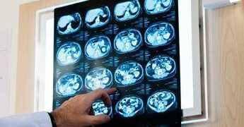 Nodulo polmonare: che cos’è, come si diagnostica e quando intervenire