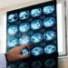 Nodulo polmonare: che cos’è, come si diagnostica e quando intervenire